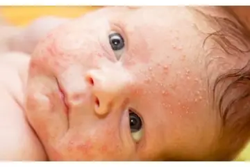 Bebeklerde Yüzde Egzama Belirtileri ve Tedavisi
