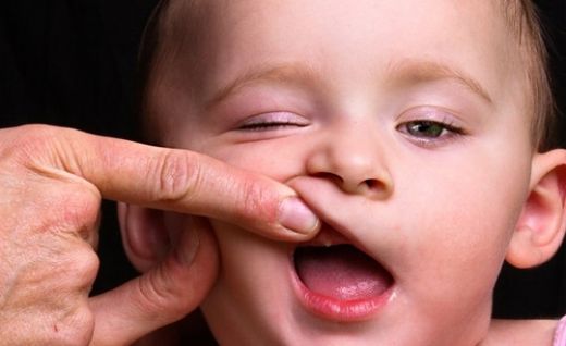 Bebeklerde Ağız İçi Pamukçuk Belirtileri ve Tedavisi