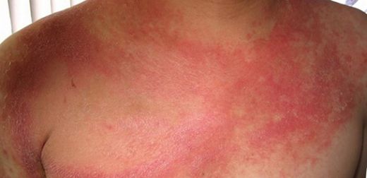 Bebeklerde Boyunda Kızarıklık Belirtileri ve Tedavisi