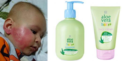Bebeklerde Egzama Kremi Kullanımı ve Faydaları Nelerdir?