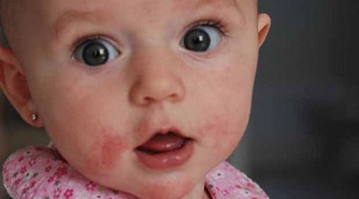 Bebeklerde Yanaklarda Kızarıklık Tedavisi